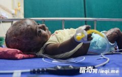 ���죡��Ӥ�޹���ȼ��� ҽ���޽�